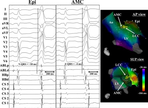 electrophysiology arrhythmia near belmont|Electrophysiology and Arrhythmias .